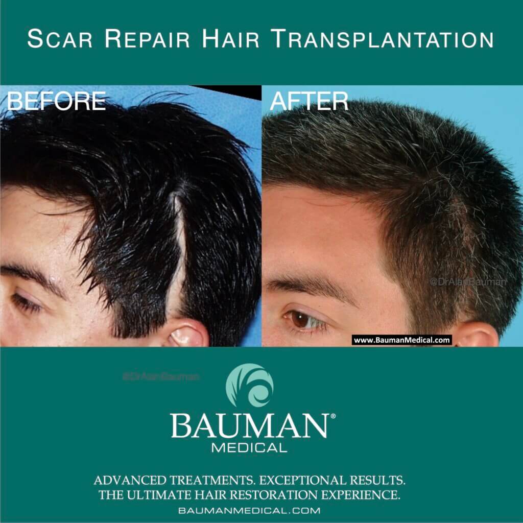 Scar-Repair-Using-Hair-Transplantation-By-Dr-Alan-Bauman