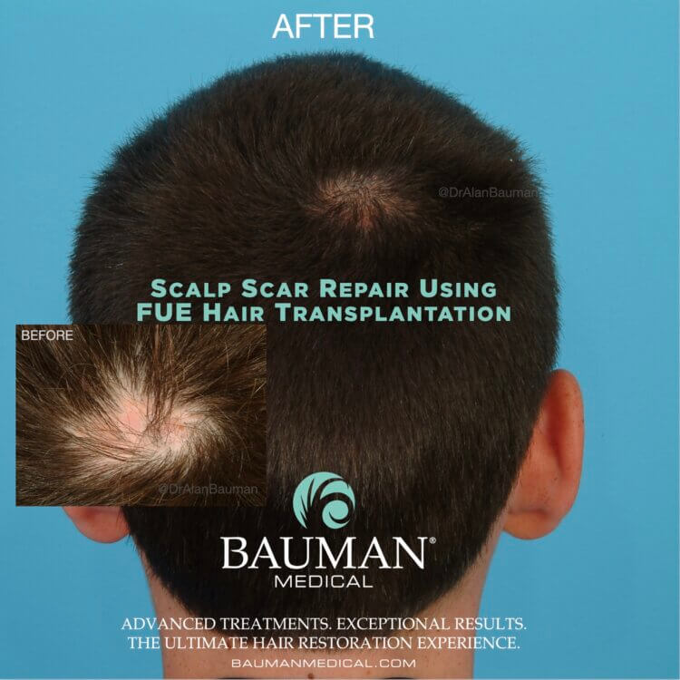 VIDEO: Boy With Scalp Scar Receives FUE Hair Transplant from Dr. Bauman