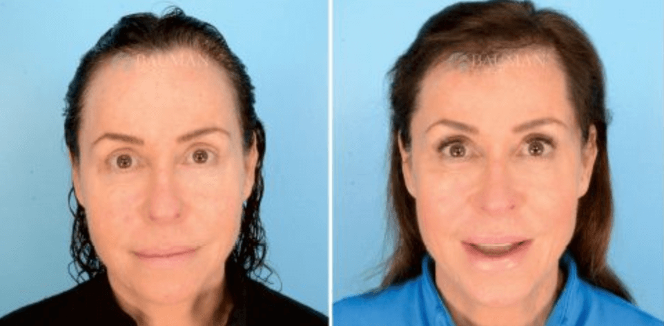 Have No Fear… Because Bauman Medical Hair Transplants Are Here! - -