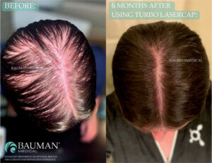 Hair Before And After Turbo Lasercap